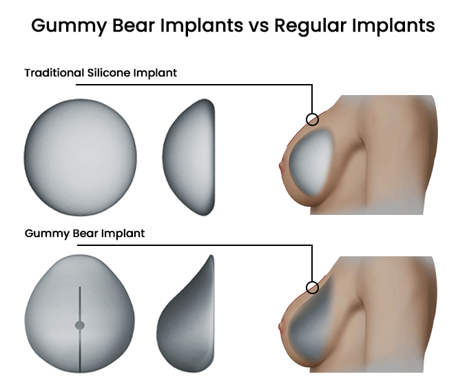 Gummy Bear Implants vs Regular Implants